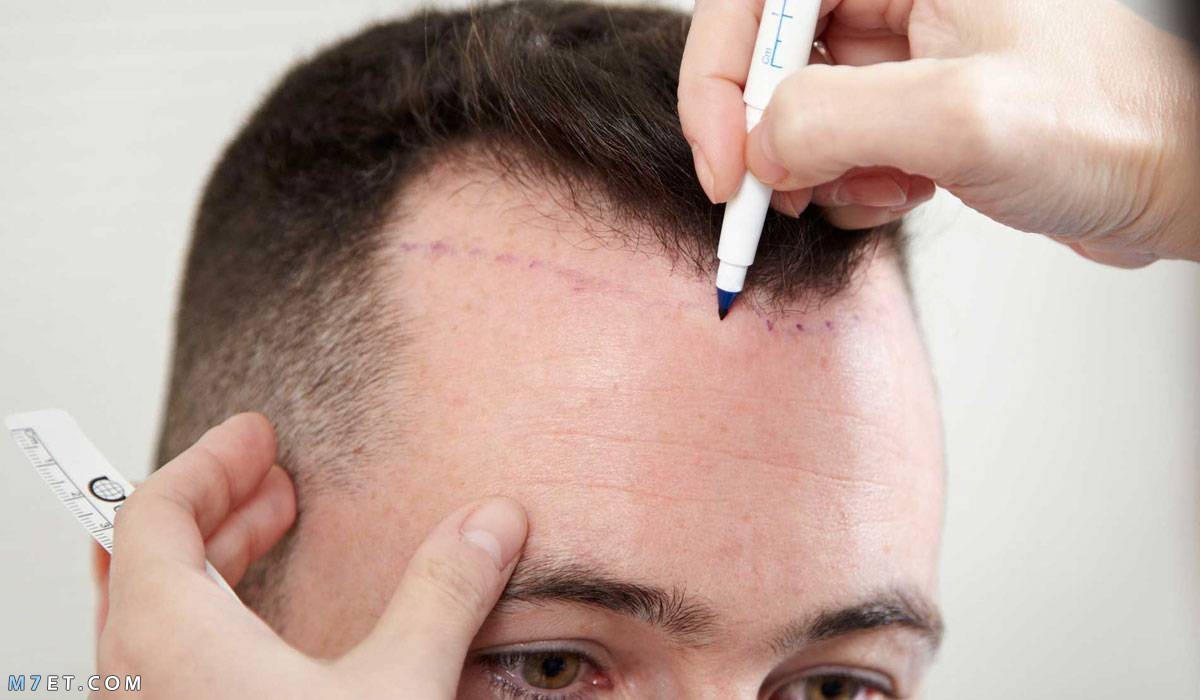 hair transplant techniques