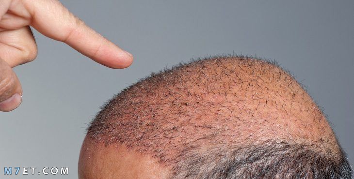 hair transplant techniques